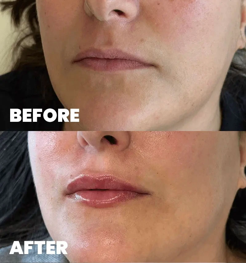 before-after-section-1-1-MJ dr. med. Marija Jaramaz