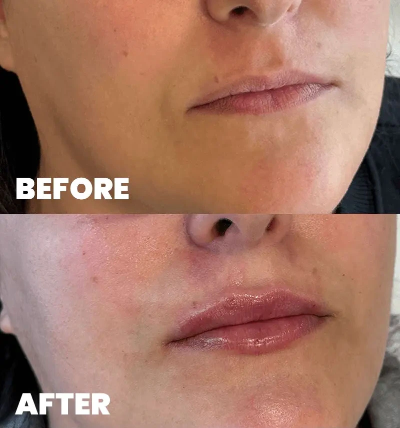 before-after-section-1-2-MJ dr. med. Marija Jaramaz