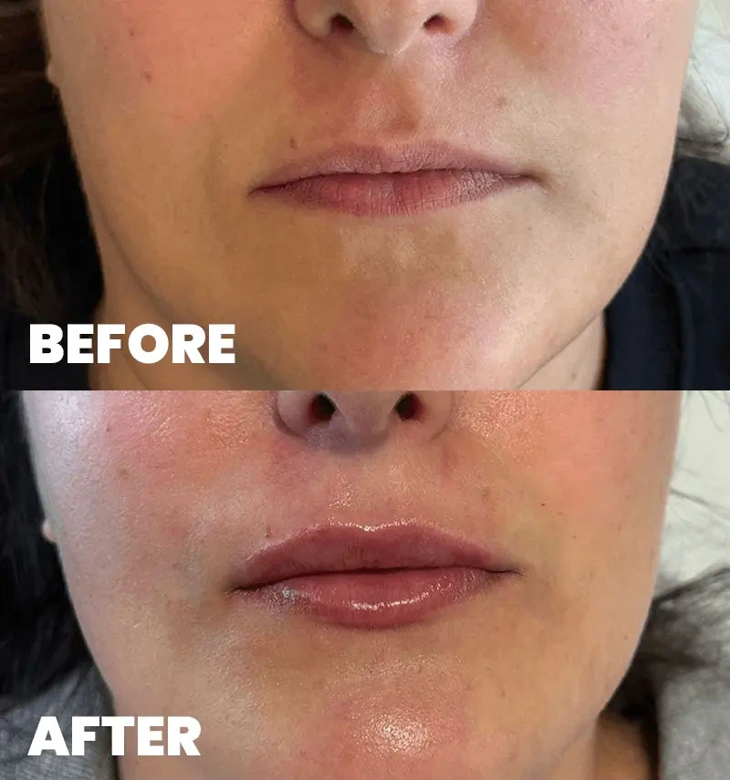 before-after-section-1-3-MJ dr. med. Marija Jaramaz
