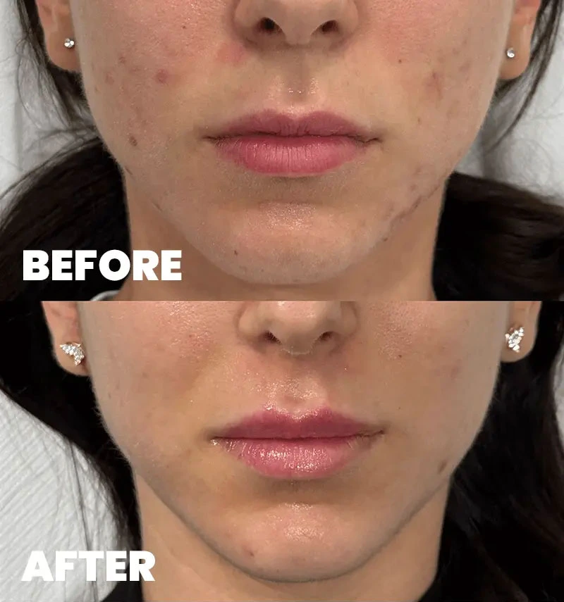 before-after-section-1-4-MJ dr. med. Marija Jaramaz
