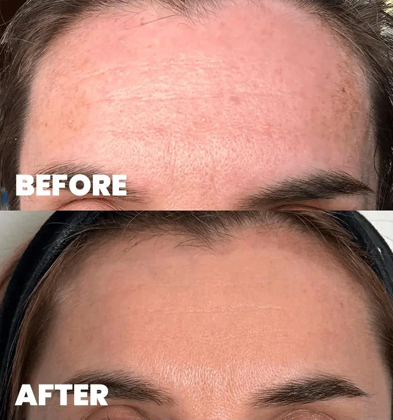 before-after-section-1-5-MJ dr. med. Marija Jaramaz