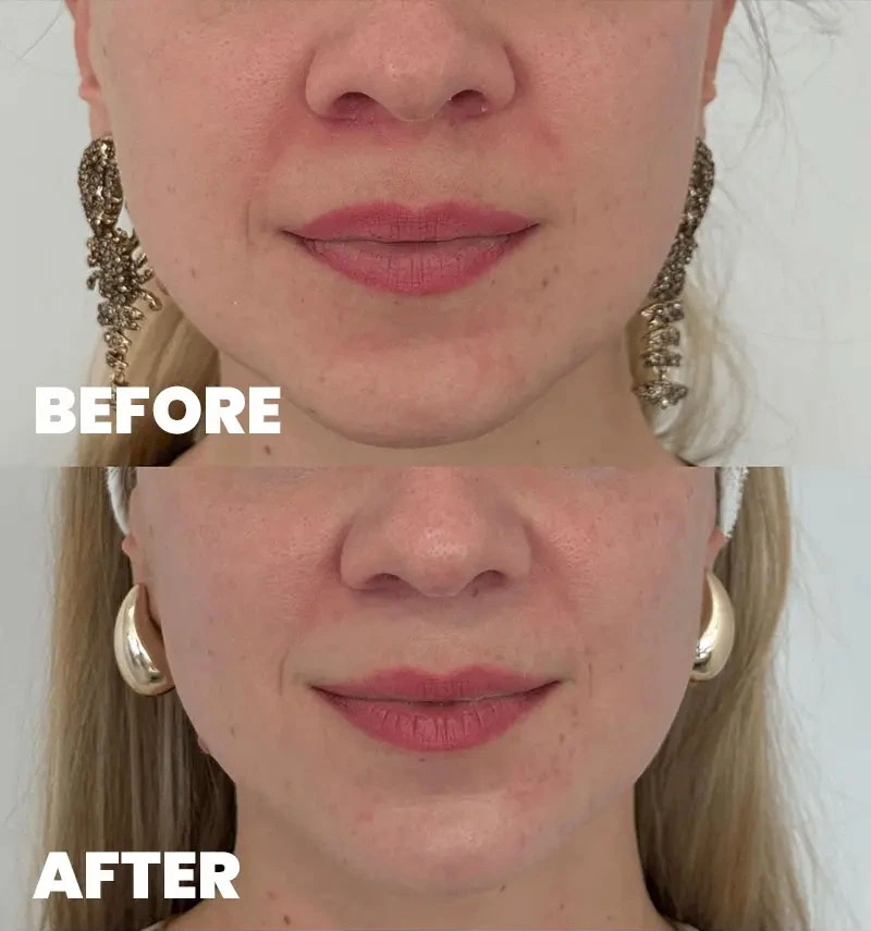 before-after-section-1-6-MJ dr. med. Marija Jaramaz