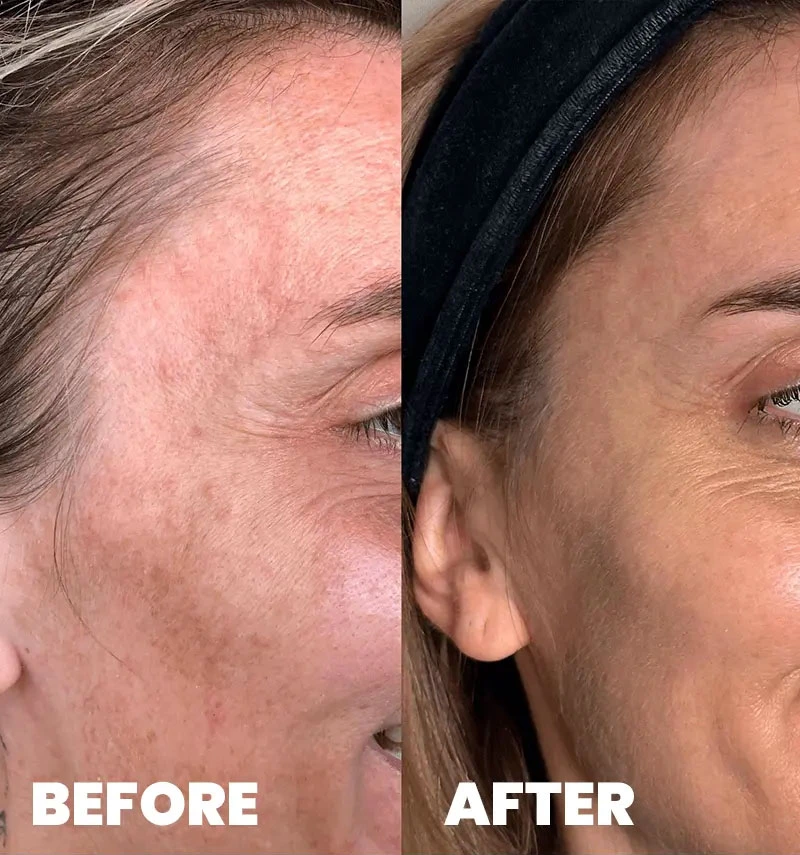 before-after-section-1-8-MJ dr. med. Marija Jaramaz