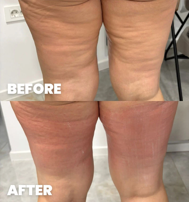 before-after-section-2-3-DB dr. med. Dora Barić